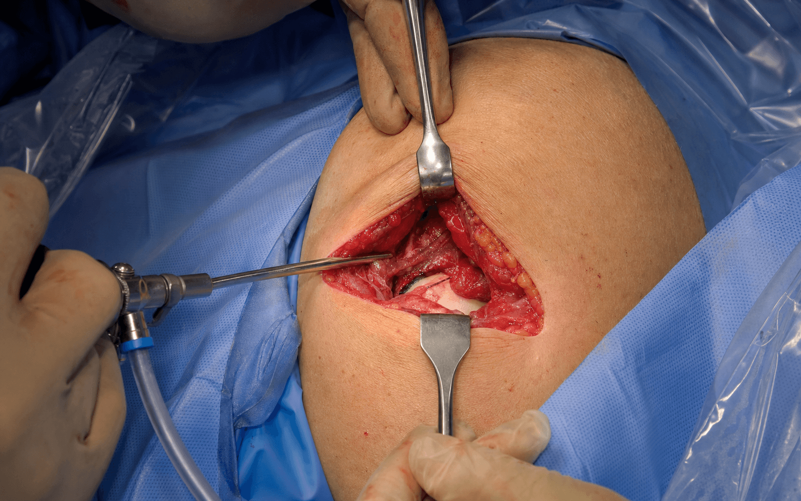 Shoulder arthroscopy approach