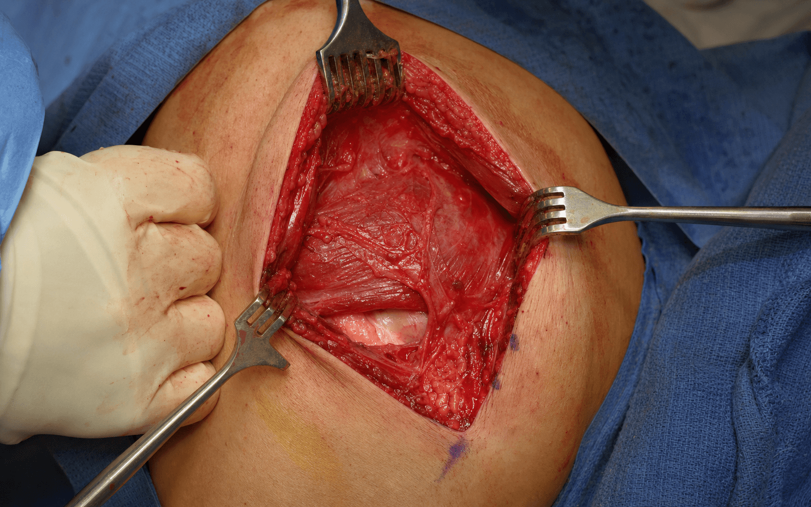 Posterior shoulder approach