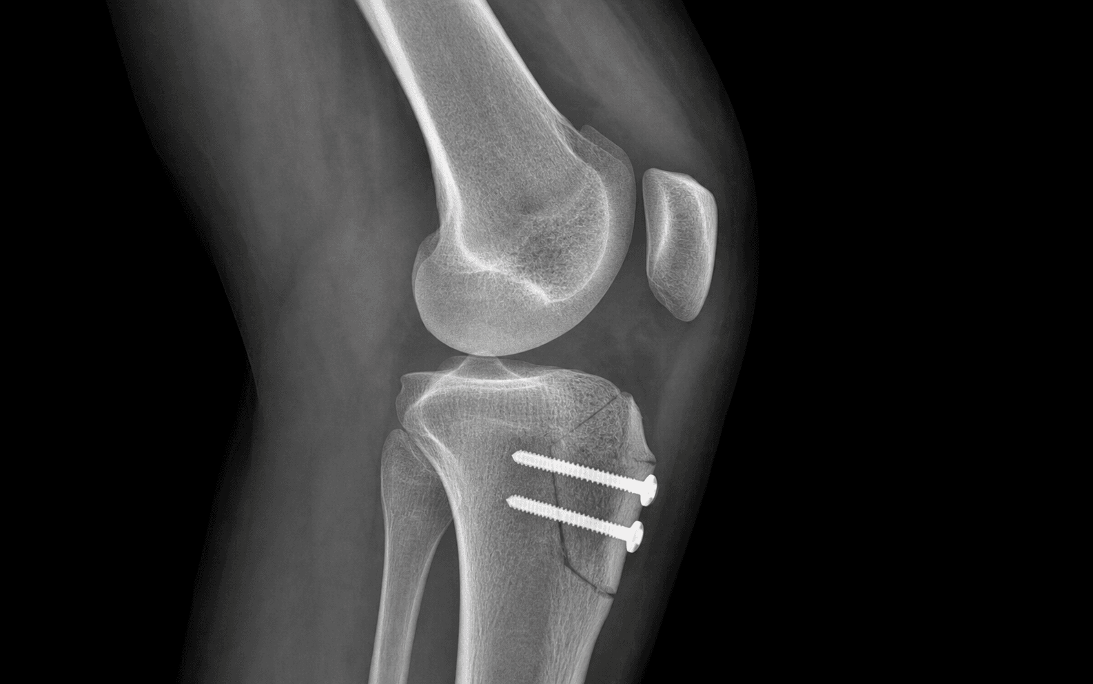 Lateral knee radiograph after tibial tubercle osteotomy