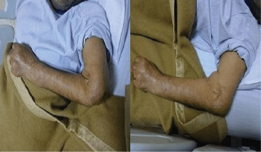 Pre-operative clinical photograph of severely deformed elbow in rheumatoid arthritis