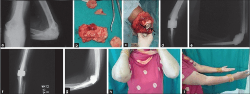 Nine-panel case series showing pre-op X-rays, tumor excision, TER insertion, and post-op X-rays