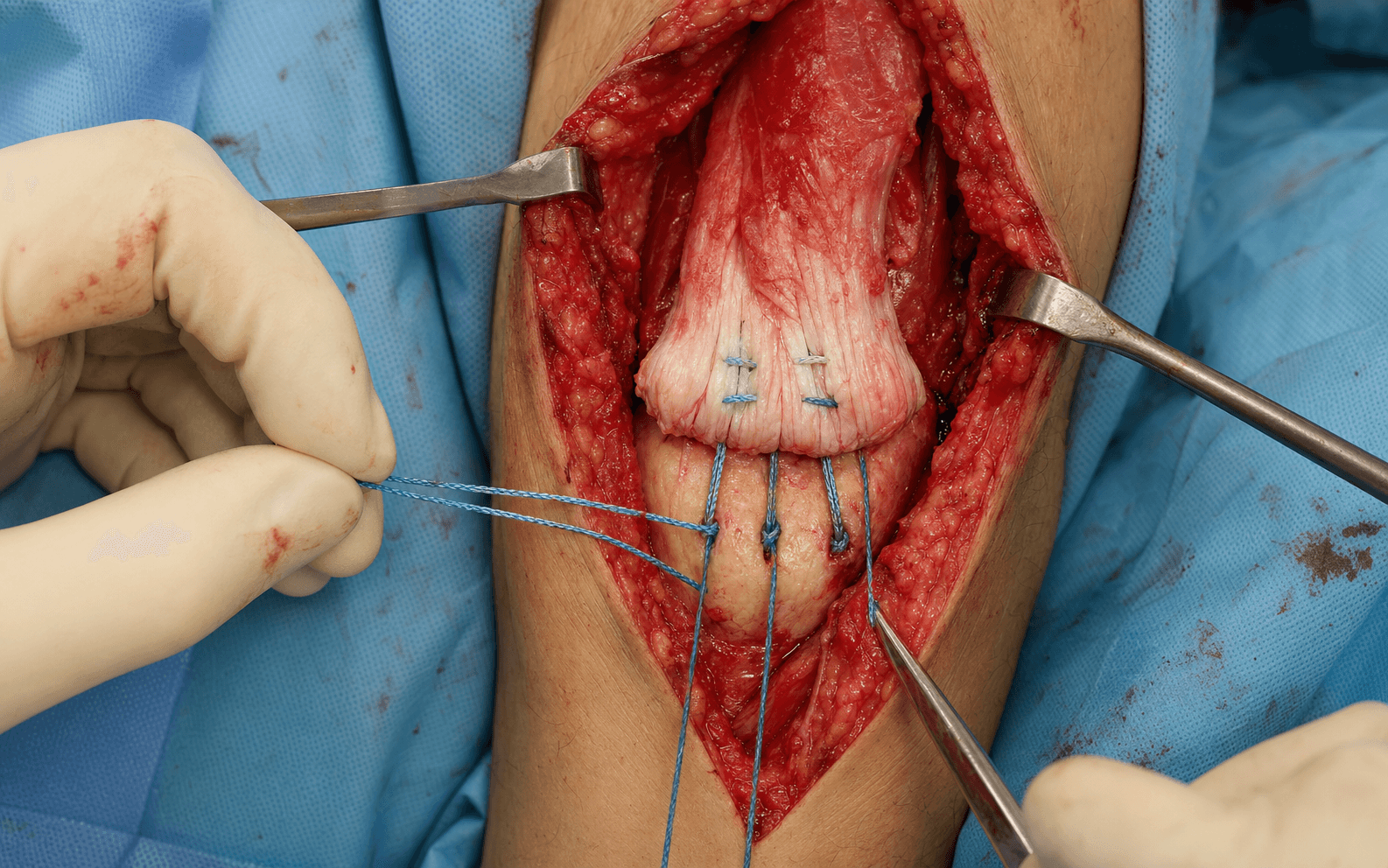 Intra-operative repair of a distal triceps tendon