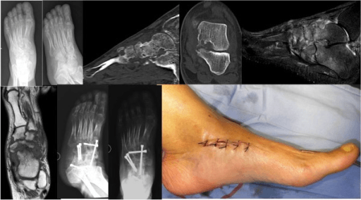 Multi-panel composite showing pre-op foot X-rays CT MRI and post-operative wound after triple arthrodesis