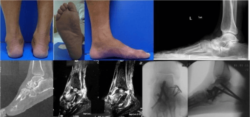 Multi-panel showing flatfoot clinical photos with ankle X-ray MRI and post-operative hardware after triple arthrodesis