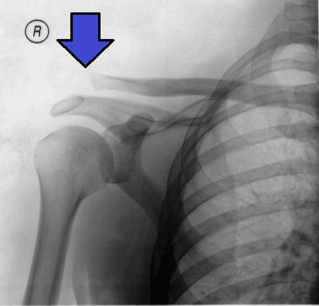 AP shoulder X-ray showing AC joint separation with arrow indicating widened joint