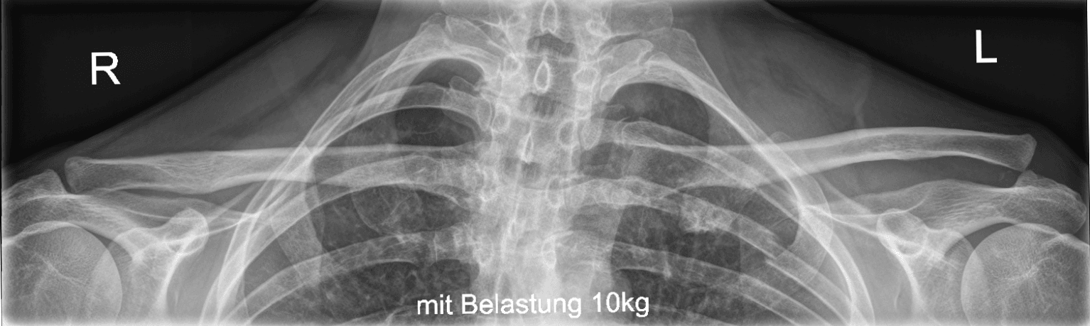 Bilateral shoulder X-ray with stress loading showing Type III AC separation