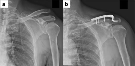 Pre-operative and post-operative X-rays showing hook plate fixation for AC dislocation