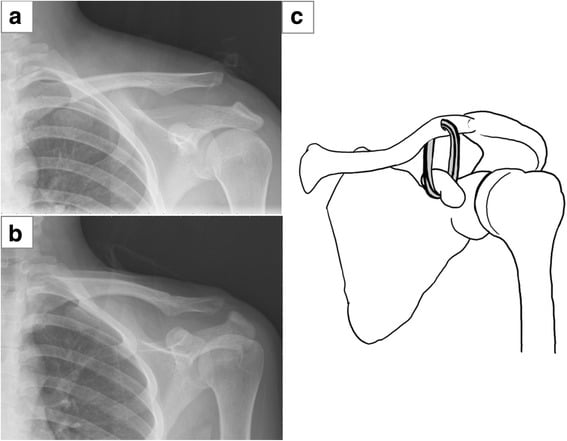CC suture fixation technique with pre/post X-rays and schematic diagram