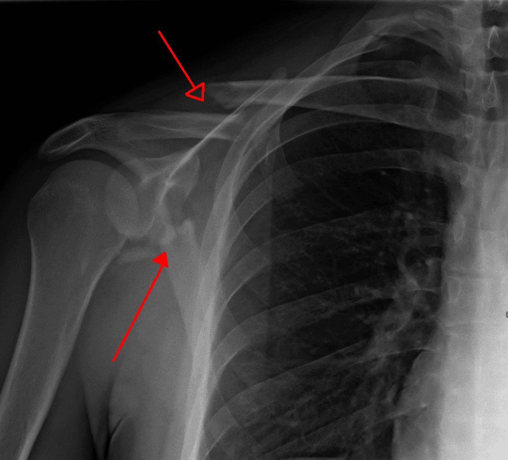 AP shoulder radiograph showing a displaced clavicle fracture together with a glenoid fracture (floating shoulder).