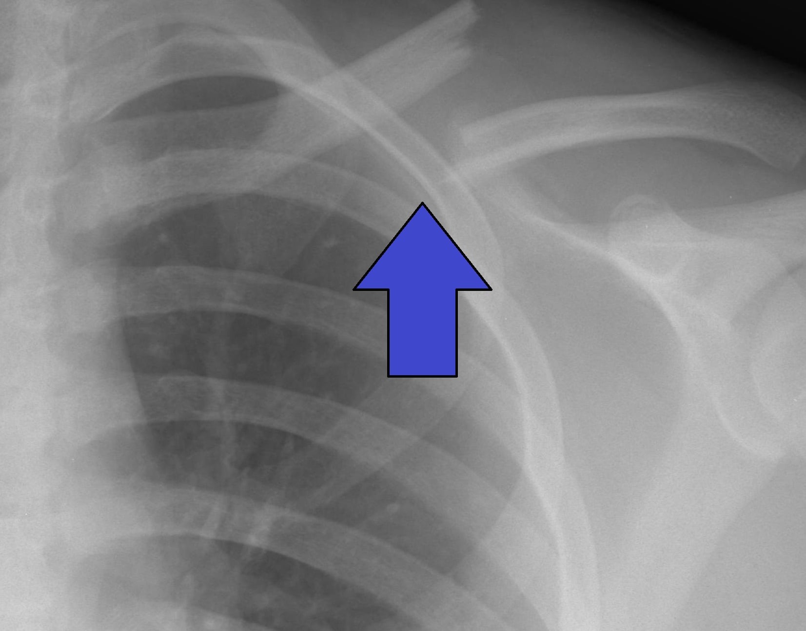 AP shoulder radiograph showing a displaced midshaft clavicle fracture, the medial fragment displaced superiorly (arrow)