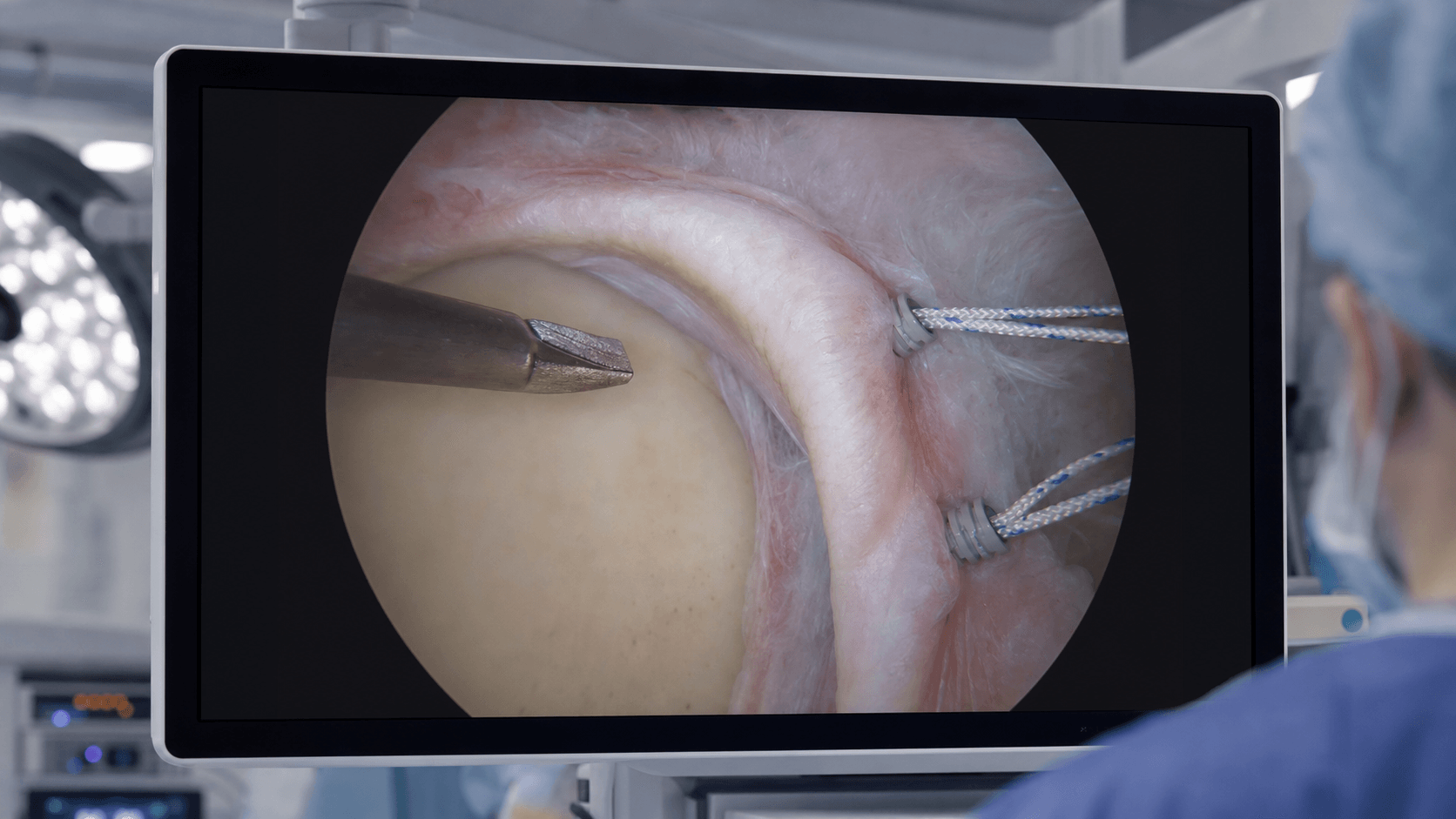 Arthroscopic shoulder repair monitor showing anterior labral mobilization and repair instruments