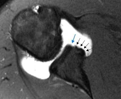 Axial fat-saturated T1 shoulder MR arthrogram showing chronic ALPSA with medialised scarred labrum on the glenoid neck