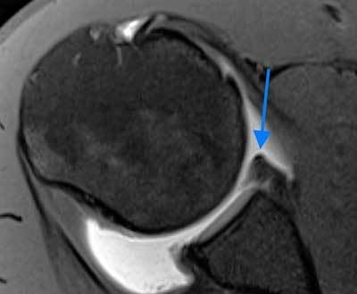 Axial fat-saturated T1 shoulder MR arthrogram showing an anteroinferior Bankart tear separated from the glenoid rim