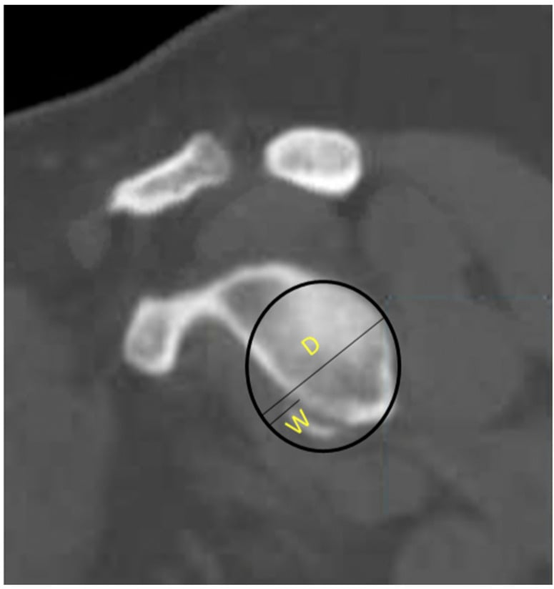 Sagittal CT of the glenoid with a best-fit inferior circle and lines labelled diameter D and defect width W