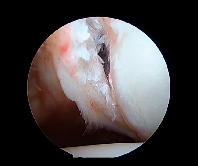 Shoulder arthroscopy showing the anteroinferior labrum elevated from the glenoid rim before repair