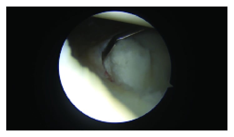 Shoulder arthroscopy showing a measured six by eight millimetre glenolabral articular disruption lesion