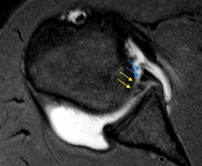 Axial fat-saturated T1 shoulder MR arthrogram showing a GLAD lesion with labral tear and adjacent glenoid cartilage defect