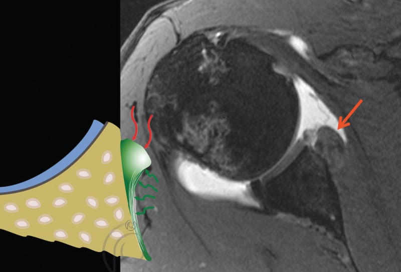 Axial MRI (MR arthrography) and diagram showing an ALPSA lesion with the detached labrum medially displaced to the glenoid neck on this shoulder scan