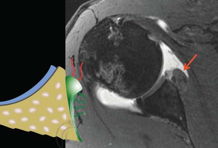 ALPSA Lesions | OrthoVellum