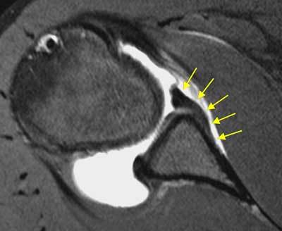 Axial fat-saturated T1 shoulder MR arthrogram showing an undisplaced Perthes lesion with intact stripped periosteal sleeve
