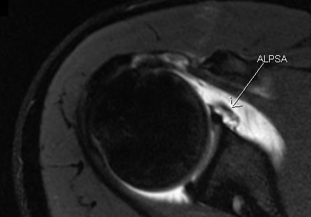 Cropped axial shoulder MR arthrogram showing ALPSA lesion