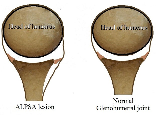 Comparison diagram of an ALPSA lesion and a normal glenohumeral joint