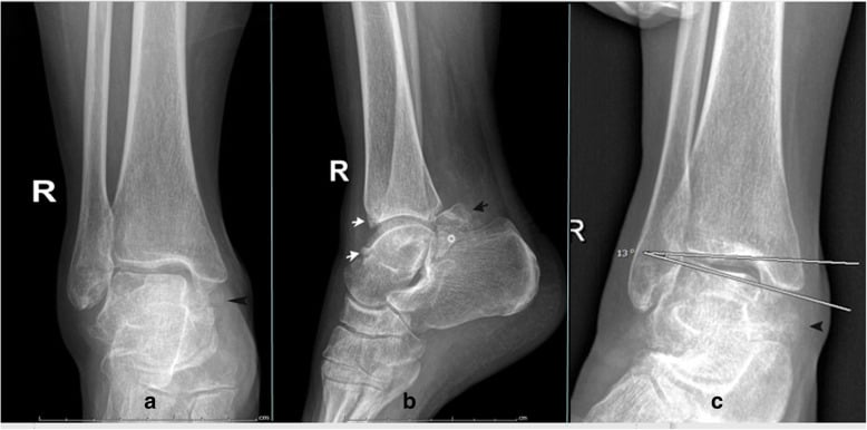 Right ankle radiographs, panels a to c: AP, lateral and a third view with a 13 degree angle measured across the joint, arrows marking anterior tibial and talar-neck osteophytes and the posterior talus, arrowheads on the medial side