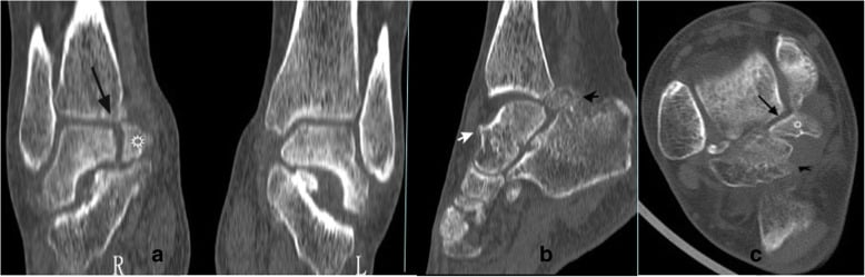 CT of combined ankle impingement: coronal images of both ankles, sagittal and axial, arrows marking a separate medial fragment and bone at the front and back of the joint