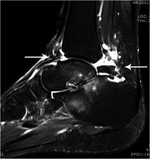 Sagittal fat-suppressed MRI of the ankle, arrows at fluid in front of and behind the joint, stars at marrow signal either side of the posterior subtalar joint