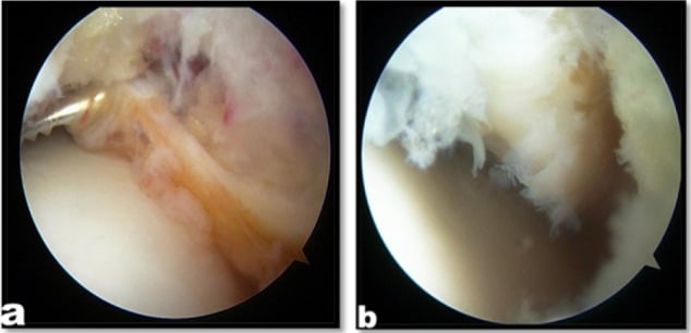 Two arthroscopic views, a and b, of scar tissue and hypertrophic synovium in the lateral gutter of the ankle