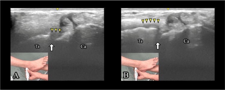 Dynamic ultrasound between talus and calcaneus in two foot positions, panels A and B, with insets showing how the foot is held, an arrow at the joint and yellow arrowheads over the soft tissue