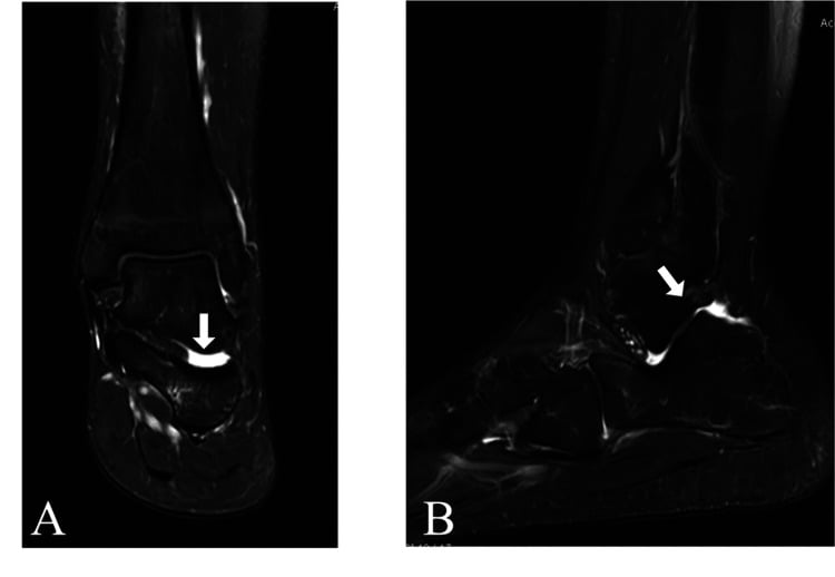 Coronal and sagittal fat-suppressed MRI, arrows marking fluid in the posterior subtalar joint
