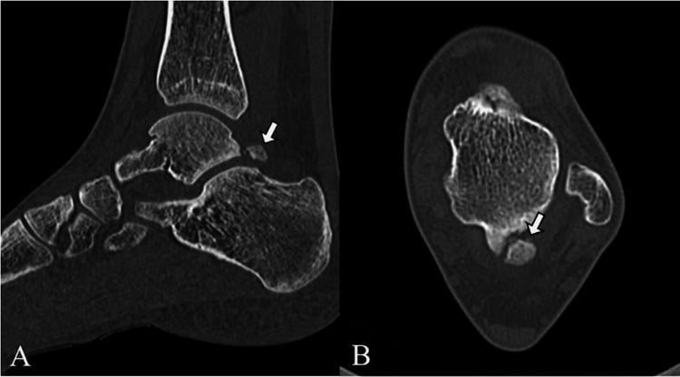 Sagittal and axial CT, arrows marking a separate ossicle behind the talus