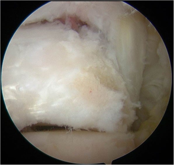 Posterior hindfoot endoscopic view