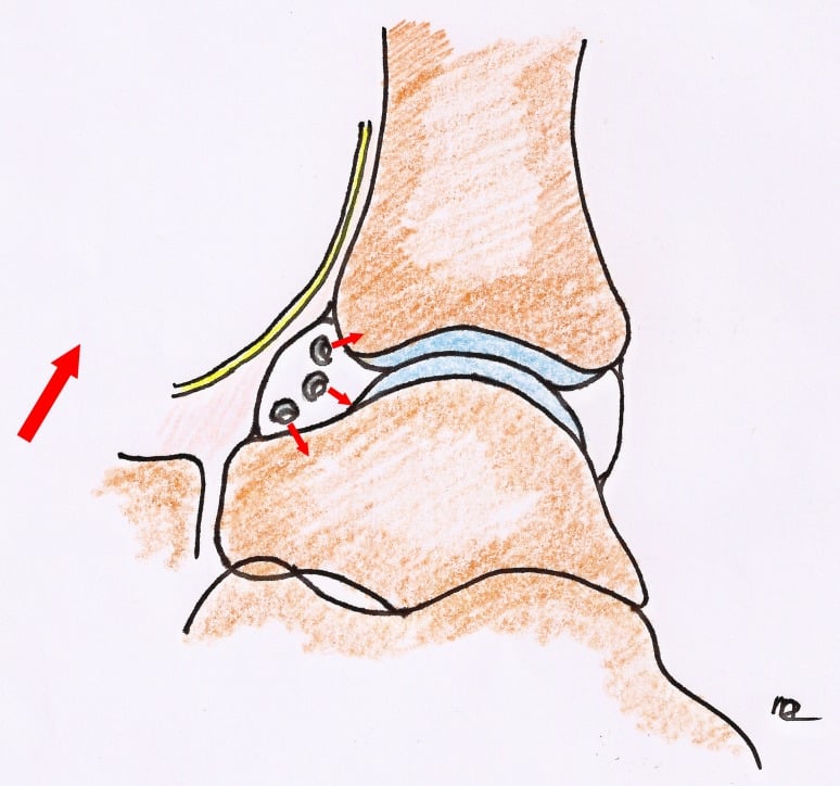 Side-view drawing of the anterior ankle, instrument positions in the anterior recess with small arrows directed towards the bone and away from an anterior structure drawn in yellow