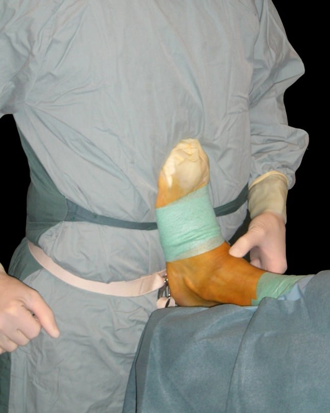 Anterior ankle arthroscopy set-up: a gowned surgeon holds the foot dorsiflexed against the body, with no distraction device in view