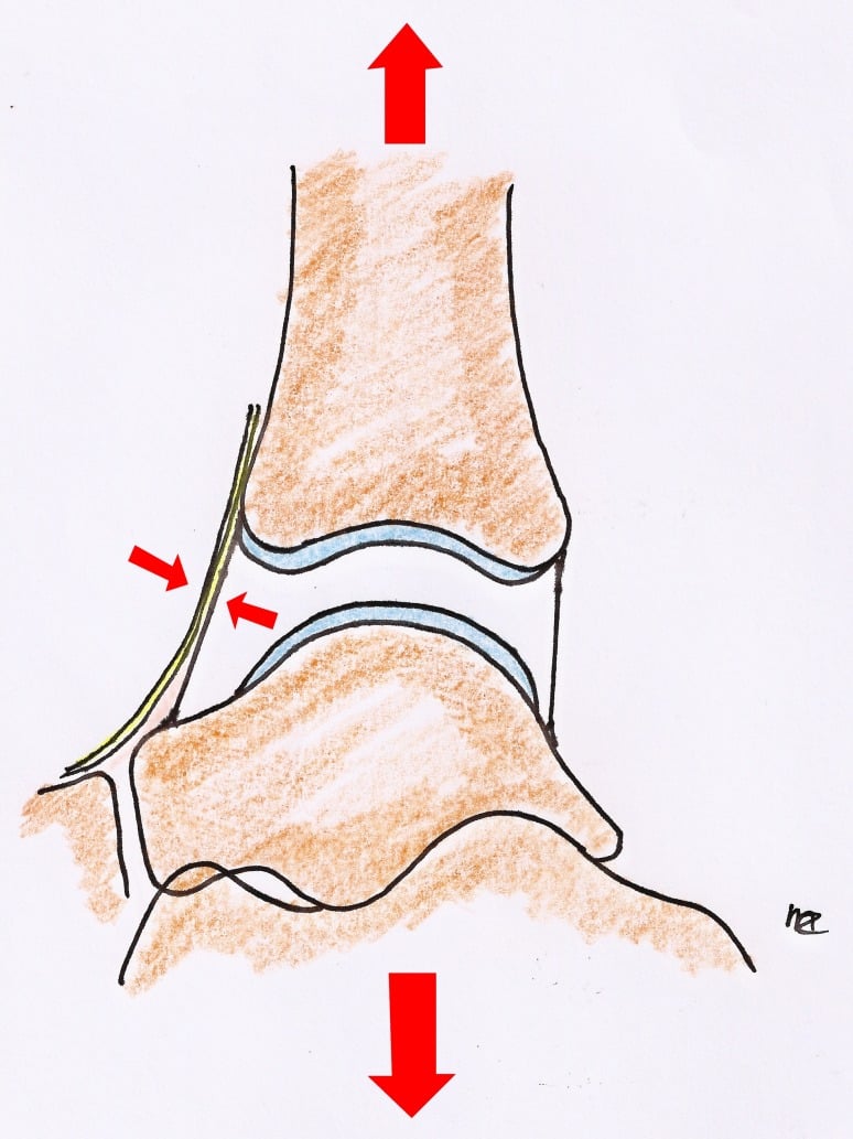 Side-view drawing of ankle distraction, large arrows pulling the joint apart and small arrows at an anterior structure drawn in yellow stretched across the front of the joint