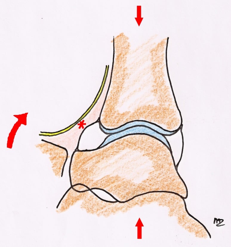 Side-view drawing of the ankle dorsiflexed without distraction, the anterior structure drawn in yellow lying clear of the joint and an asterisk marking the anterior space