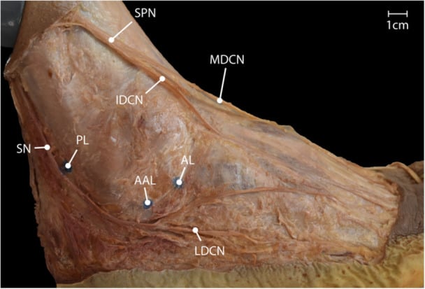 Cadaveric dissection of the lateral ankle with labelled nerves SPN, IDCN, MDCN, LDCN and SN and portal markers AL, AAL and PL, 1 cm scale bar