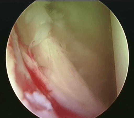 Arthroscopic view of a Bankart lesion