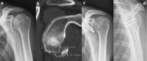 Bony Bankart lesion evaluation and surgical fixation