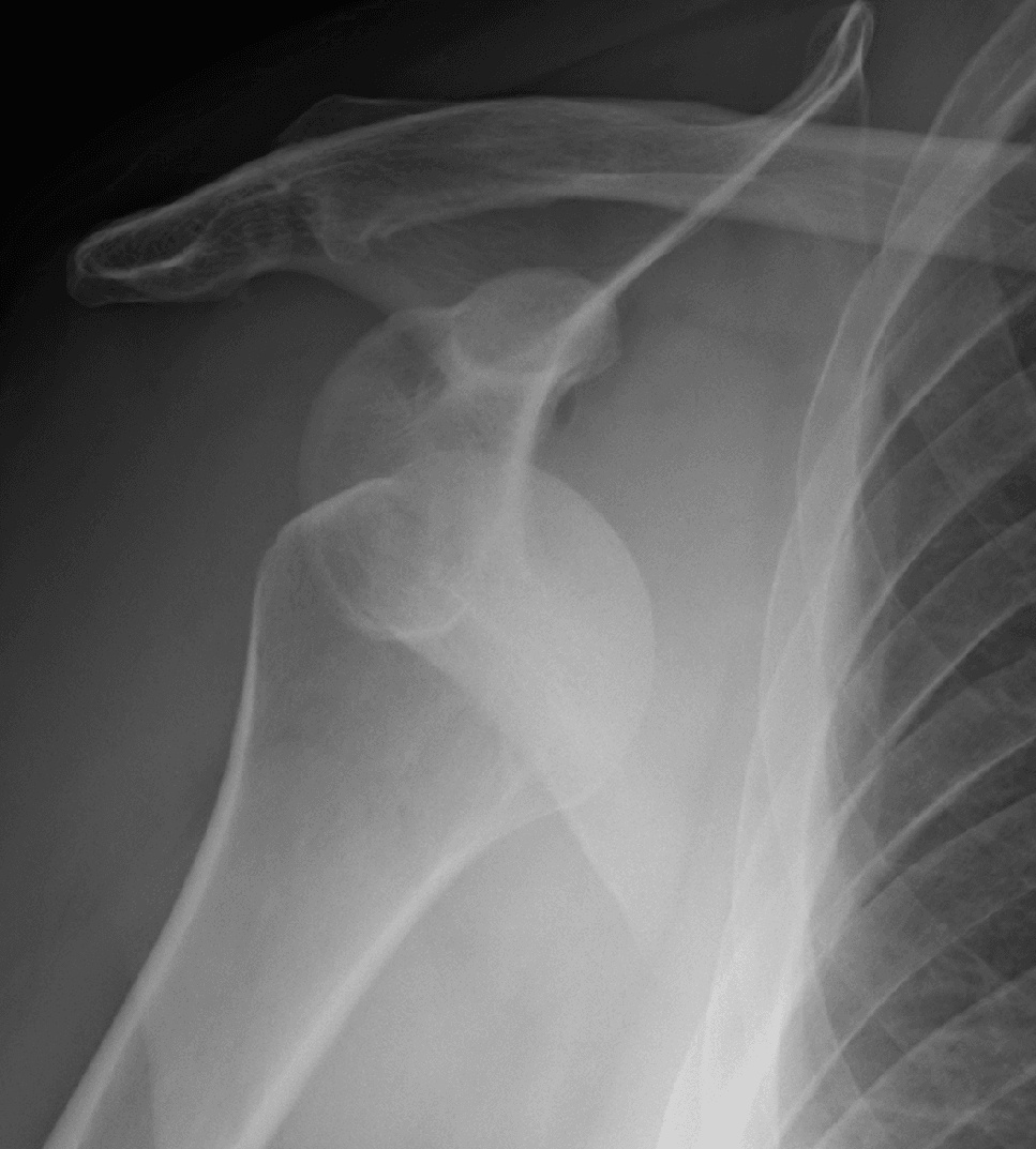 AP radiograph of an anterior glenohumeral dislocation