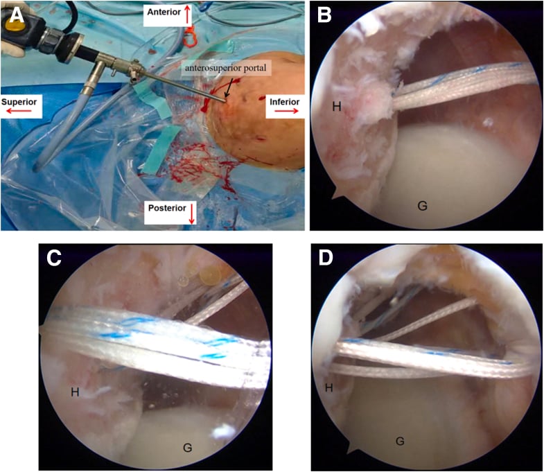 Arthroscopic remplissage sequence showing Hill-Sachs preparation, anchor placement and infraspinatus capsulotenodesis