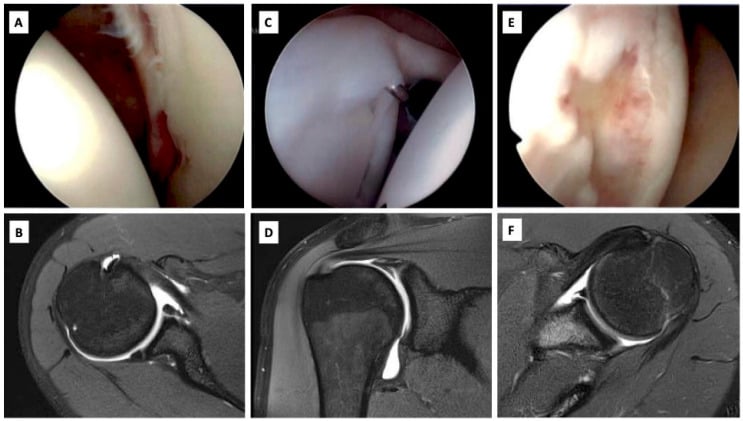 Paired arthroscopic and MR arthrographic images of Bankart, SLAP and Hill-Sachs lesions