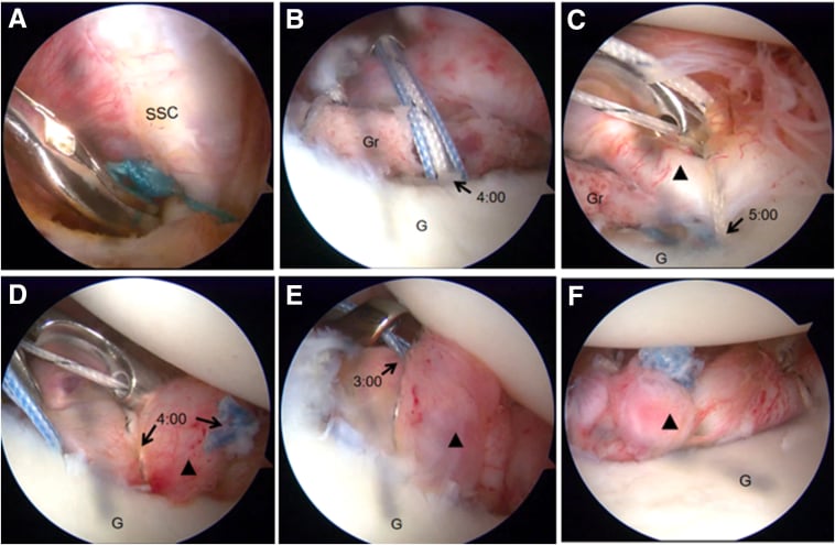 Six-step arthroscopic Bankart repair sequence showing capsulolabral mobilisation, suture passage and restored bumper