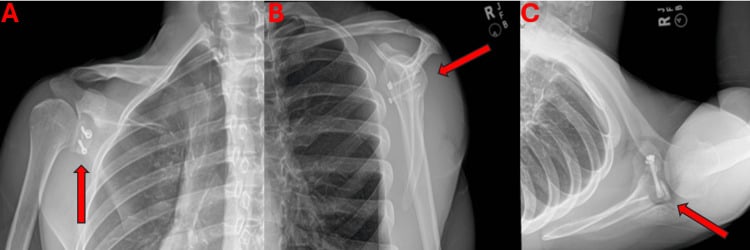 Radiographs showing displaced coracoid graft and failed hardware after Latarjet