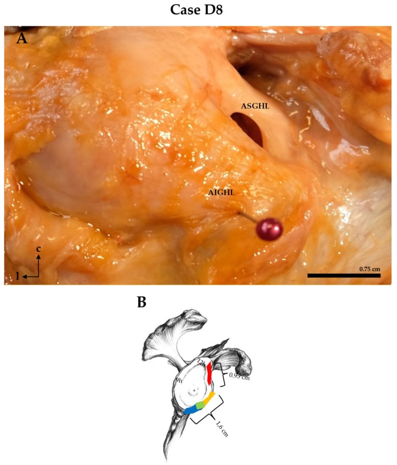 Cadaveric anterior shoulder dissection and glenoid clock-face map showing a conjoined middle and anteroinferior glenohumeral ligament variant