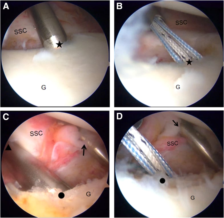 Four-step arthroscopic sequence showing low anteroinferior glenoid anchor placement