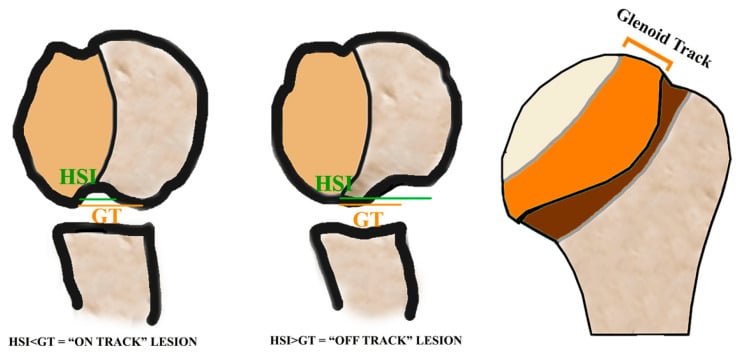 Diagram comparing on-track and off-track Hill-Sachs lesions using the Hill-Sachs interval and glenoid track