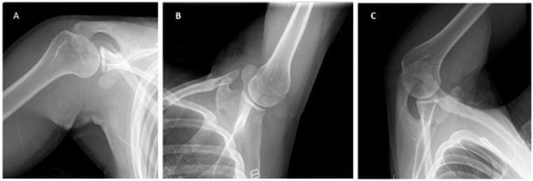 Stryker notch, West Point and Bernageau radiographic views used in anterior shoulder instability